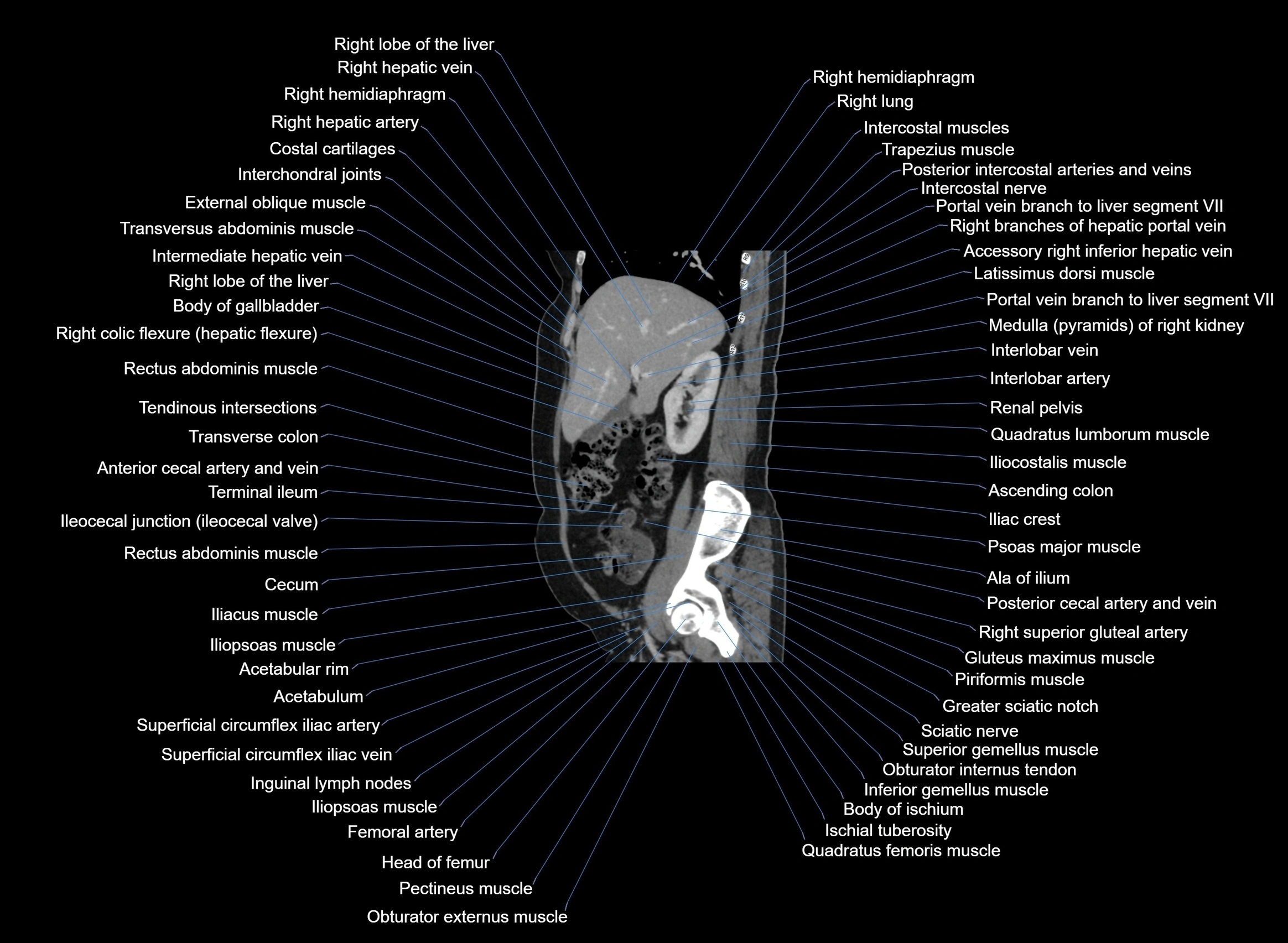 CT Abdomen sagittal cross sectional anatomy labelled radiology image -00080.webp